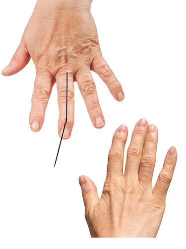 arthrose des doigts